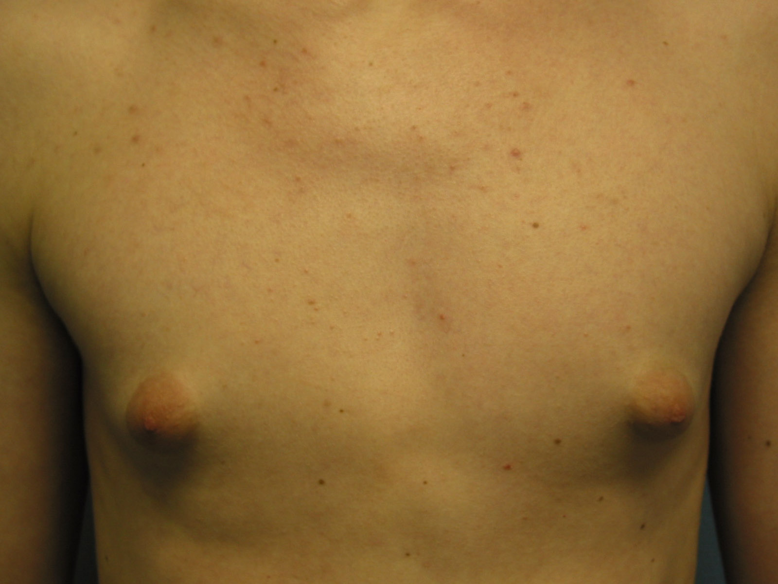 шишка в левой груди у мужчин фото 36