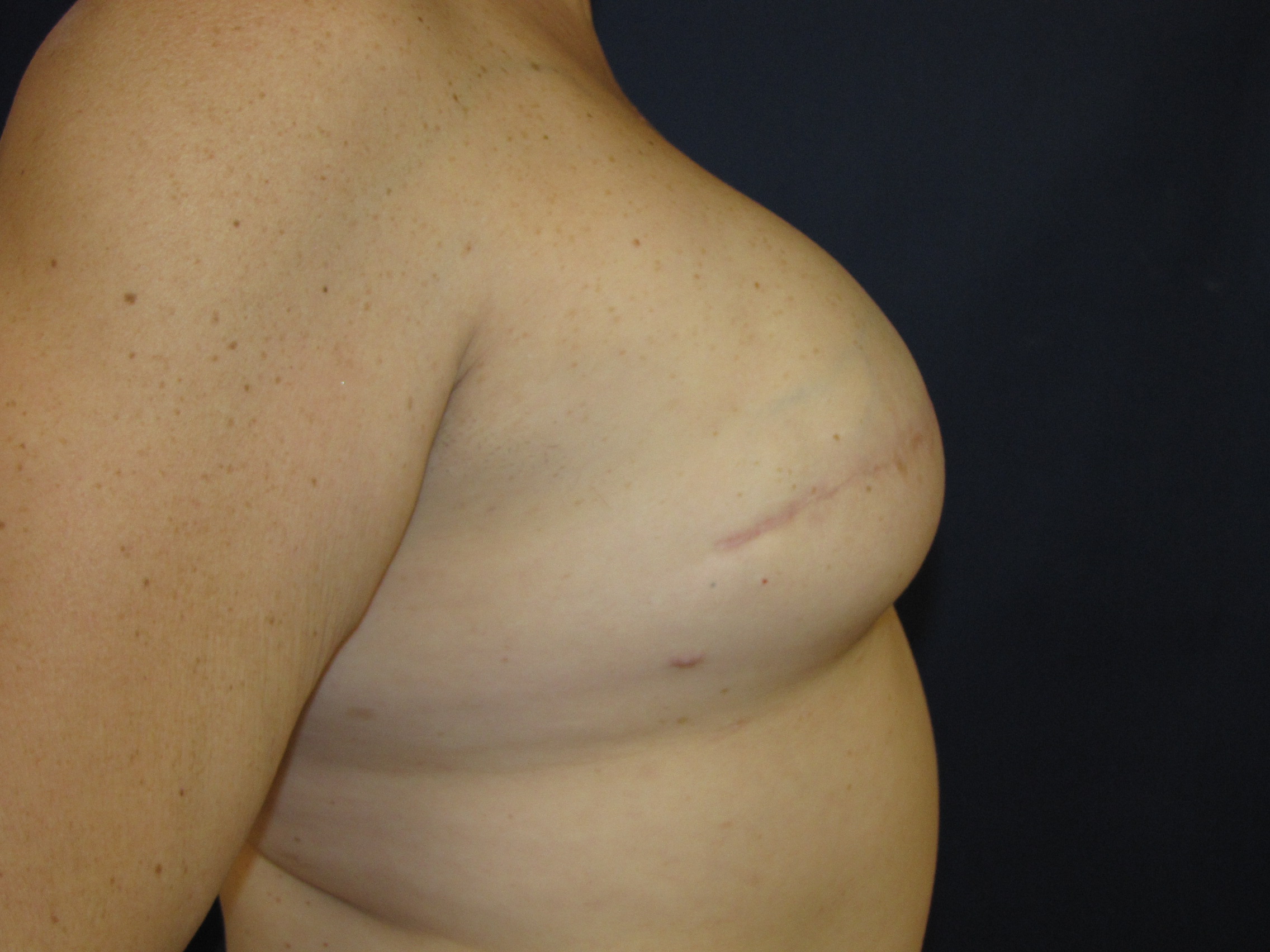Tissue expander breast reconstruction radiation Scottsdale Phoenix