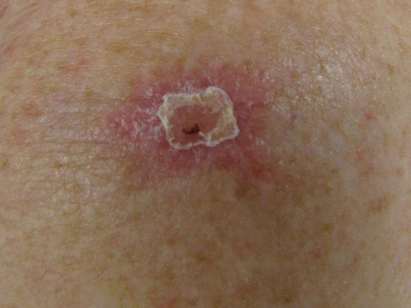 skin cancer blisters