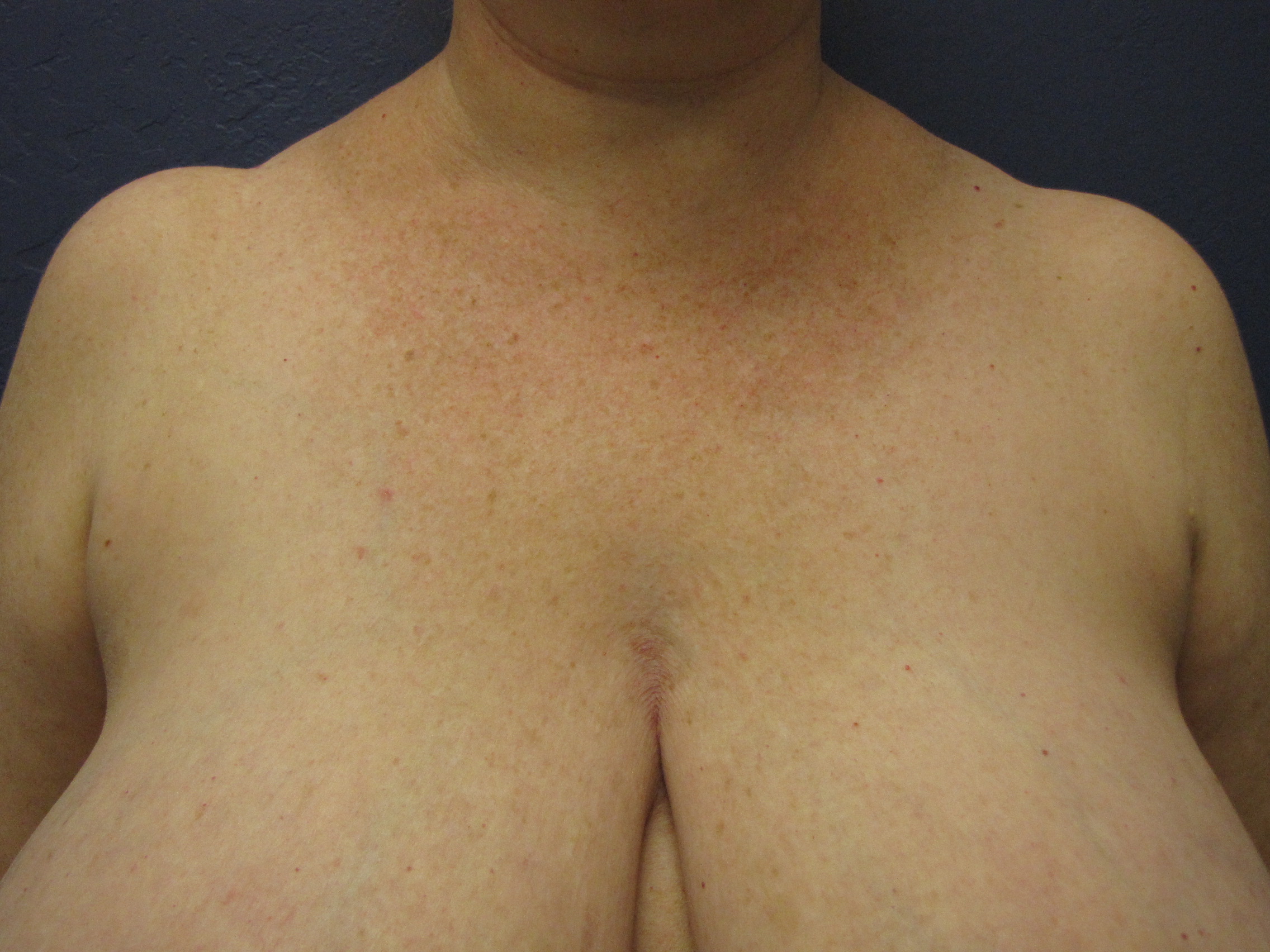 Autologous Fat Transfer for the Reconstruction of Brassiere Strap