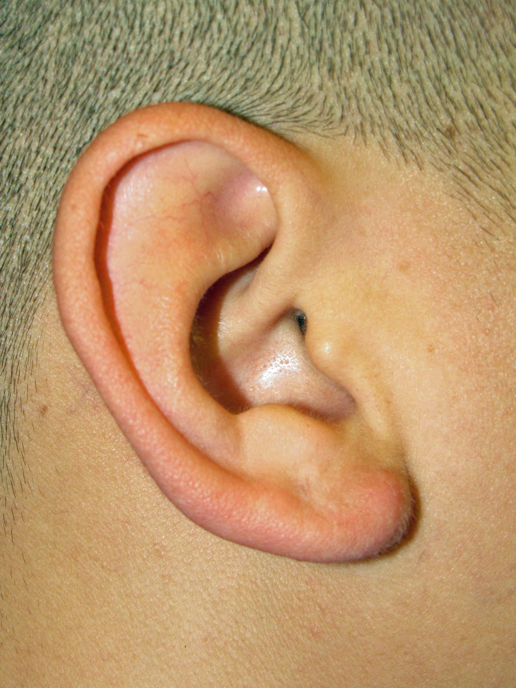 keloids on ears