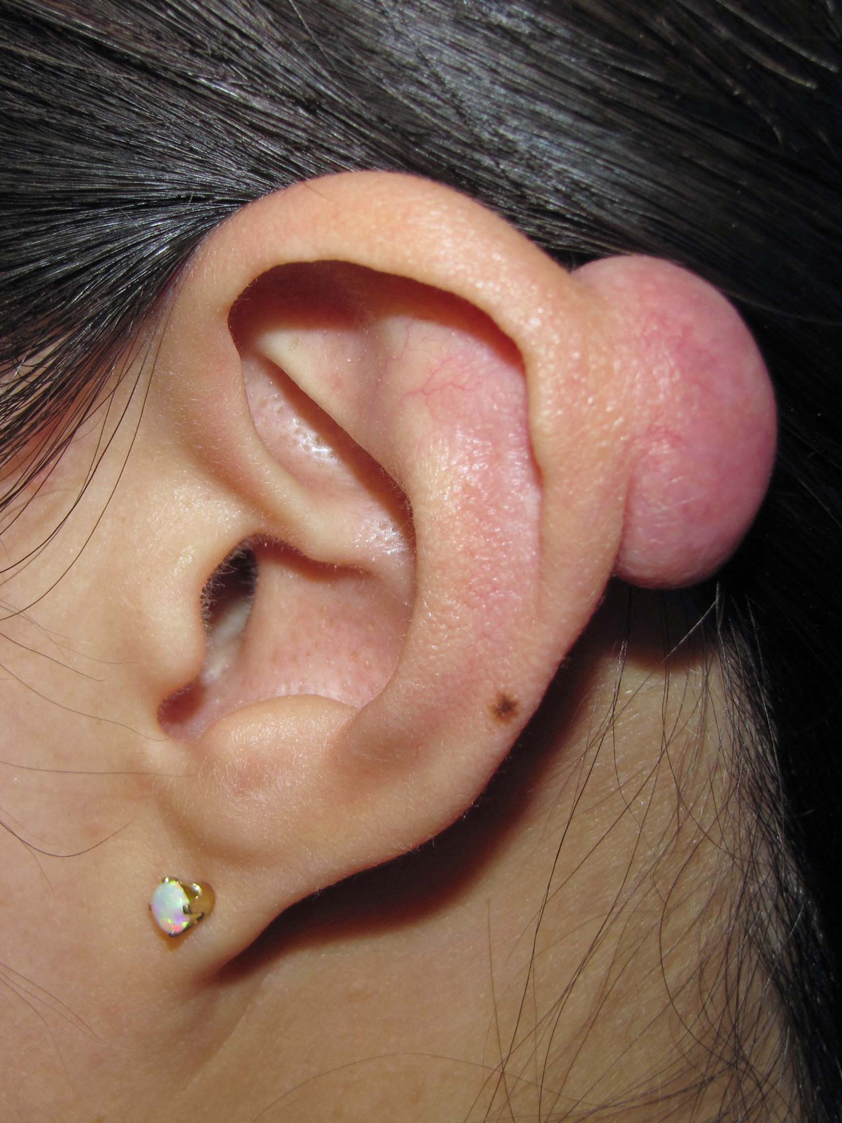Infected auricular keloid secondary to attempted selfamputation of a gauge  earring  BMJ Case Reports