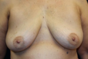 B) After implant removal - frontal view