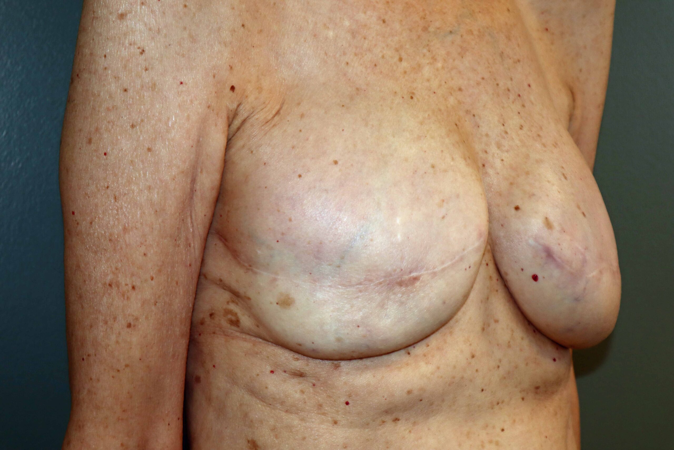Patient F - Bilateral Breast Reconstruction following Breast