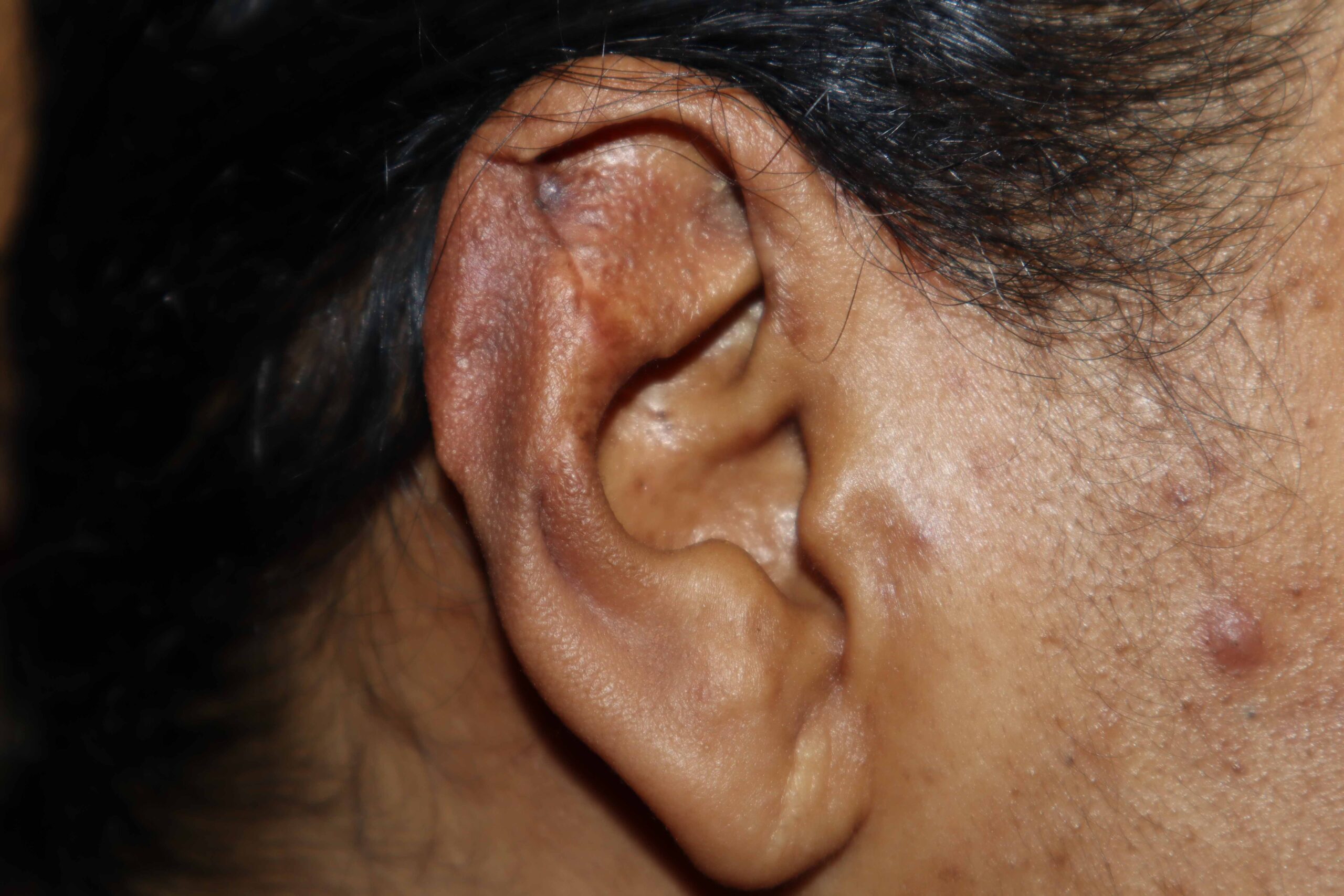 Giant relapsing earlobe keloid – Successful combined treatment by surgery  and pressure earring